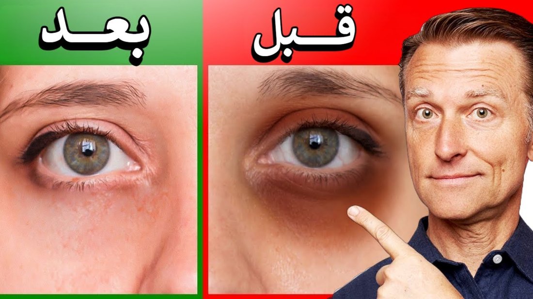كيفية علاج الهالات السوداء تحت العين نهائياً بوصفات منزلية مجربة