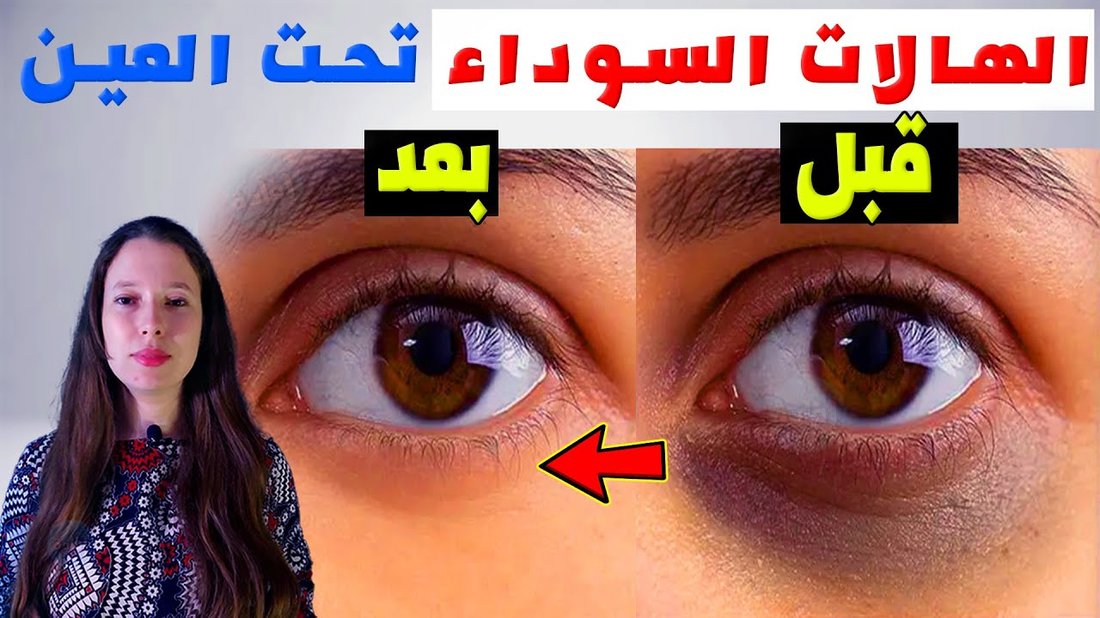 كيفية علاج الهالات السوداء تحت العين نهائياً بوصفات منزلية مجربة
