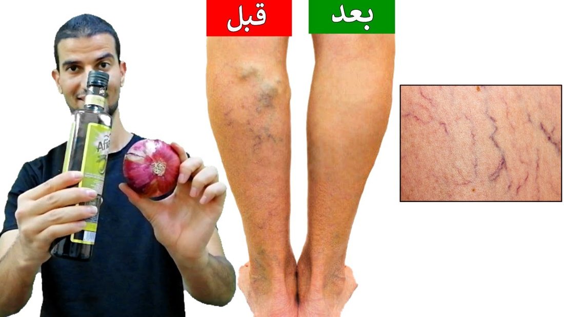 كيف تعالج تشققات القدمين في ليلة واحدة وتستعيد نعومتهما