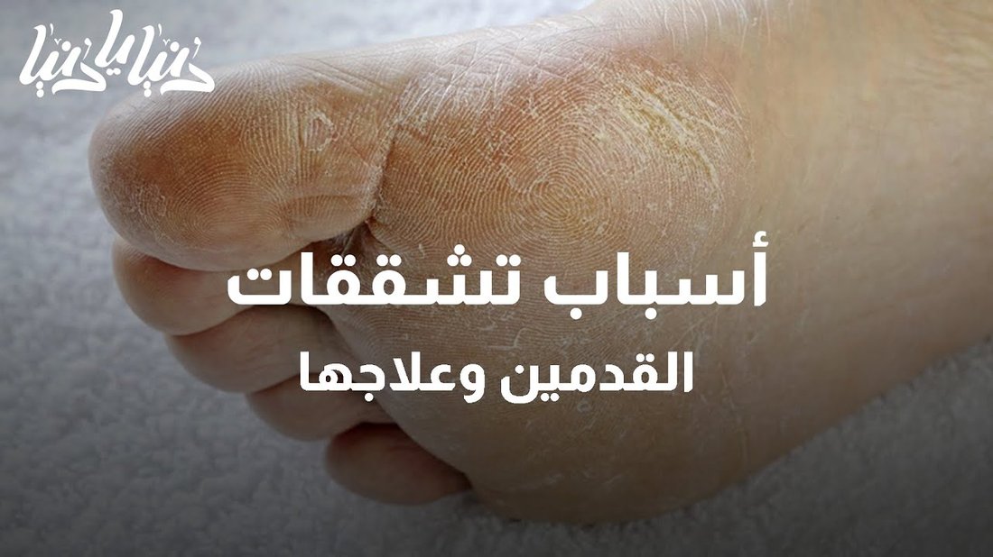 كيف تعالج تشققات القدمين في ليلة واحدة وتستعيد نعومتهما