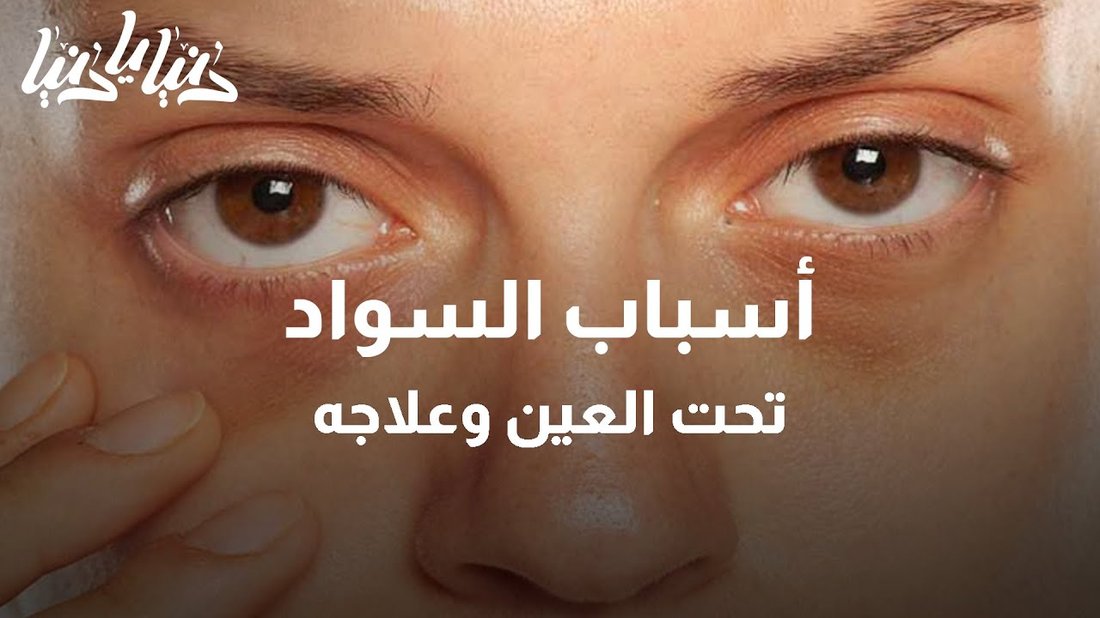 أسباب السواد تحت العين وطرق علاجها النهائية بالماسكات الطبيعية