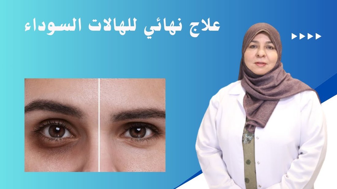 أسباب السواد تحت العين وطرق علاجها النهائية بالماسكات الطبيعية