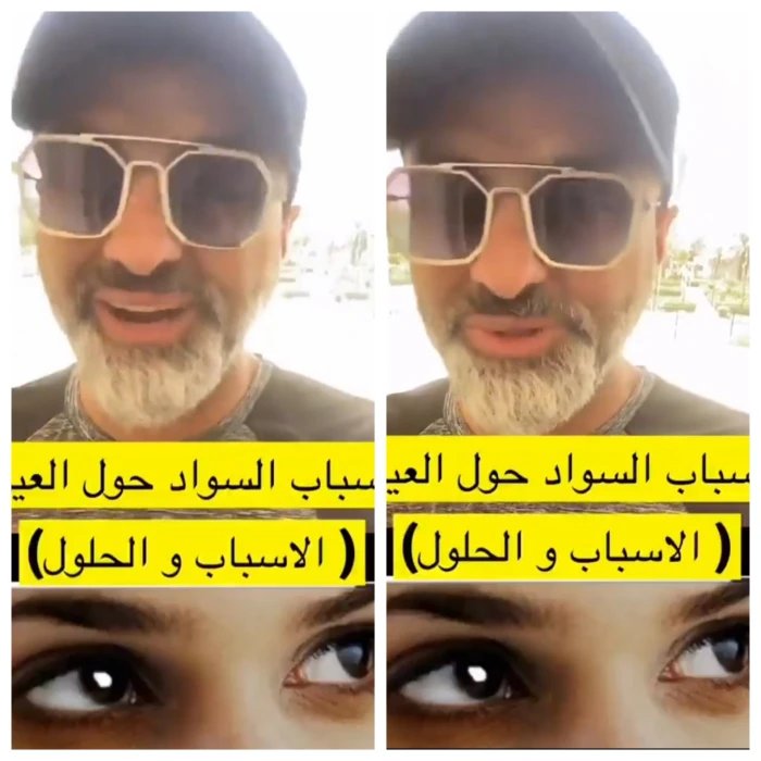 أسباب السواد تحت العين وطرق علاجها النهائية بالماسكات الطبيعية