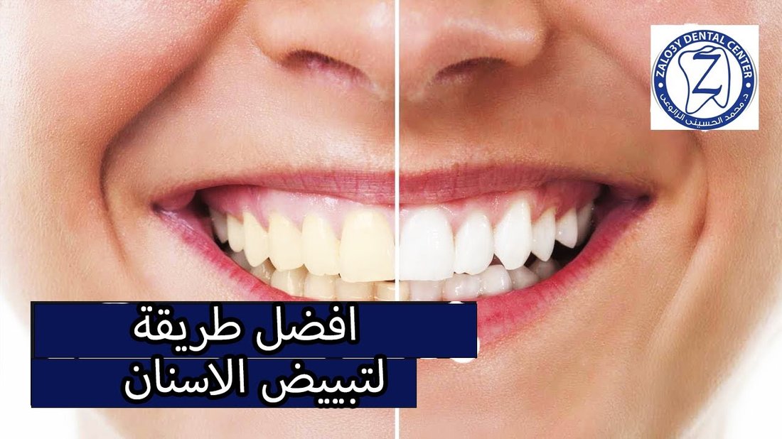 أفضل الطرق الطبيعية لتبييض الأسنان في المنزل دون إلحاق ضرر بالمينا